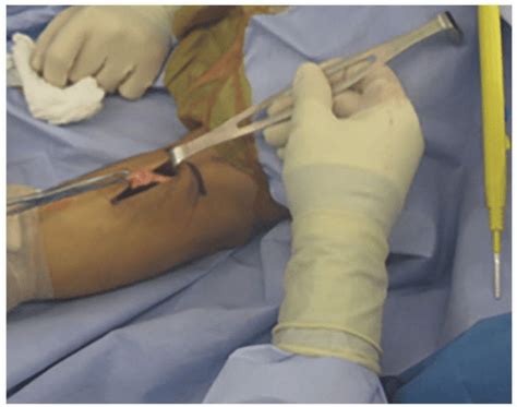 upper arm muscle repair surgery